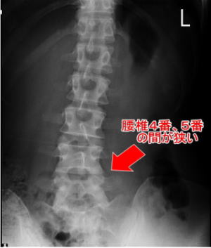 施術前の腰椎