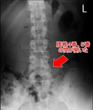 施術後の腰椎